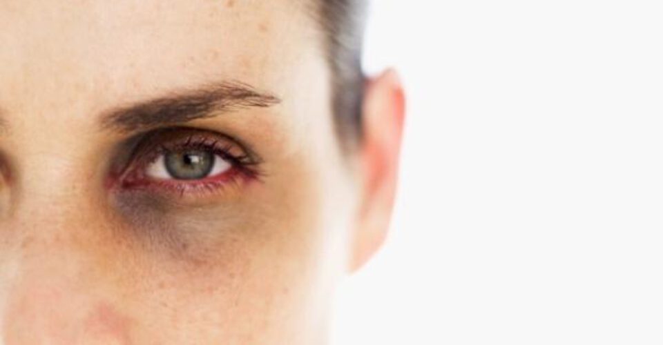 آیا روشی دائمی برای رفع سیاهی زیر چشم وجود دارد؟
