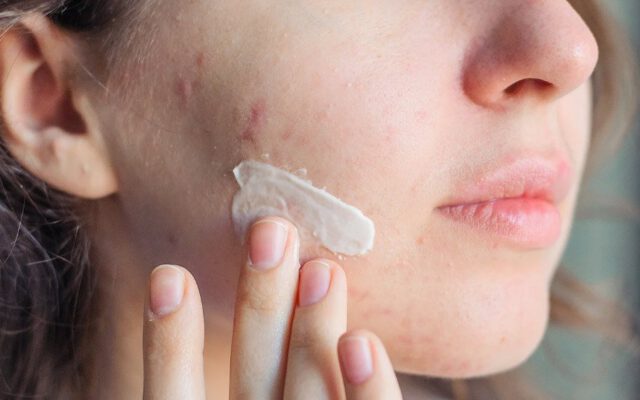 برای درمان جوش صورت در پوست‌های خشک چه باید کرد؟