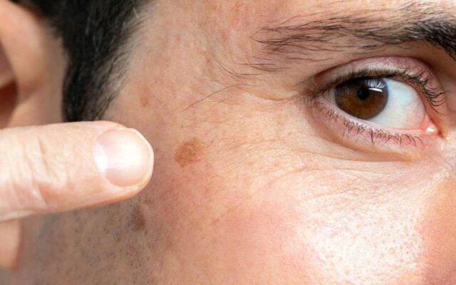 ۷ راهکار برای خلاص شدن از شر لکه‌های پوستی ناشی از افزایش سن