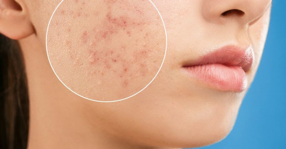 سالیسیلیک اسید چیست و چه تاثیری در بهبود آکنه و سلامت پوست دارد؟