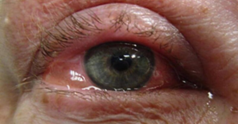 با التهاب چشم، ناشی از حساسیت چه کنیم‌؟