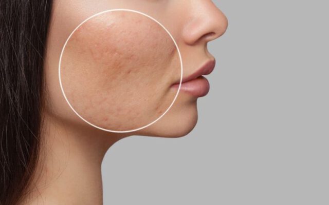 ۷ روش کارآمد برای درمان قطعی منافذ باز پوست