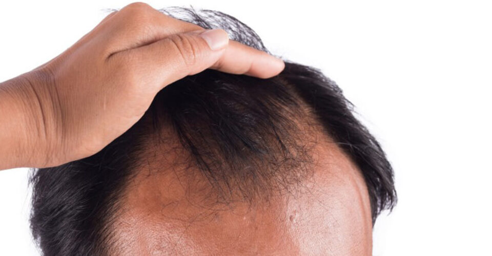 چرا موی جلوی سر میریزه و چجوری درمانش کنیم؟
