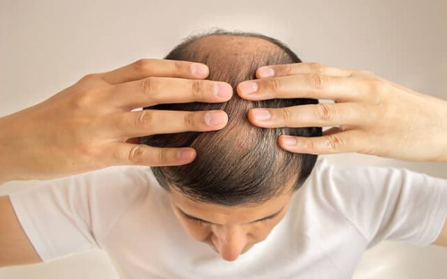 افزایش هورمون تستوسترون در مردان = ریزش موی شدید
