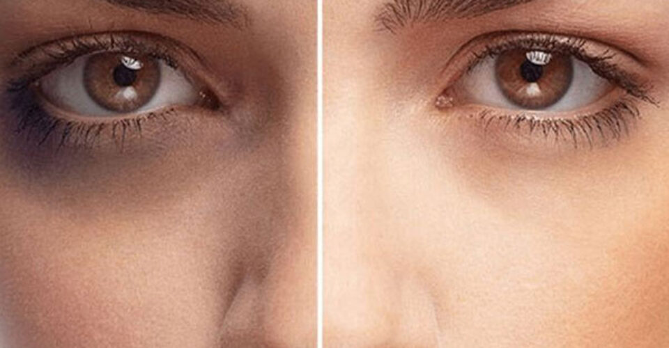 سیاهی دور چشم نشانه کمبود چه ویتامینی است؟ | ویتامین‌های مؤثر در کاهش سیاهی دور چشم