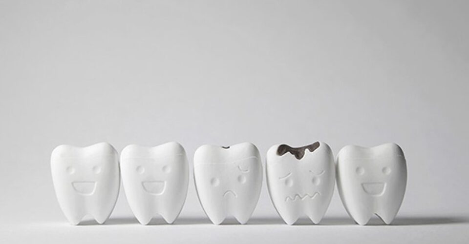 همه چیز درباره‌ی علت پوسیدگی دندان، راه‌های پیشگیری و درمان آن