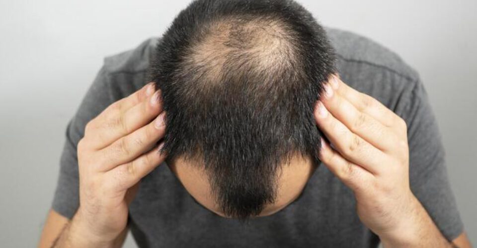 پکیج درمان ریزش موی شدید در مردان