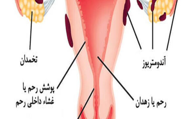 ویدئو دستگاه داخل رحمی (IUD)