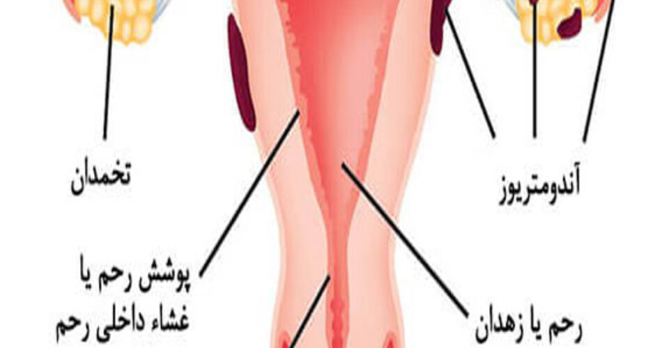 ویدئو دستگاه داخل رحمی (IUD)