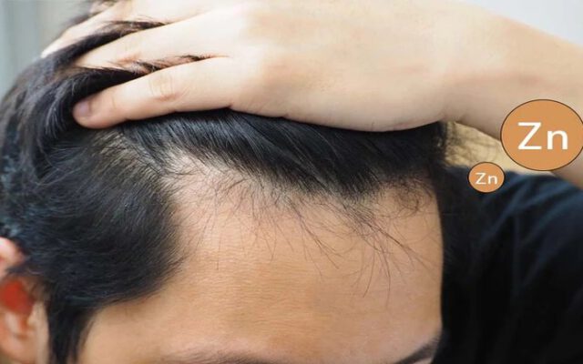 بررسی فواید قرص زینک برای پوست و مو