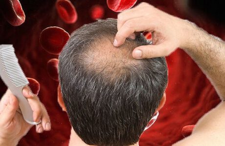 بهترین قرص آهن برای درمان ریزش موی ناشی از کمخونی