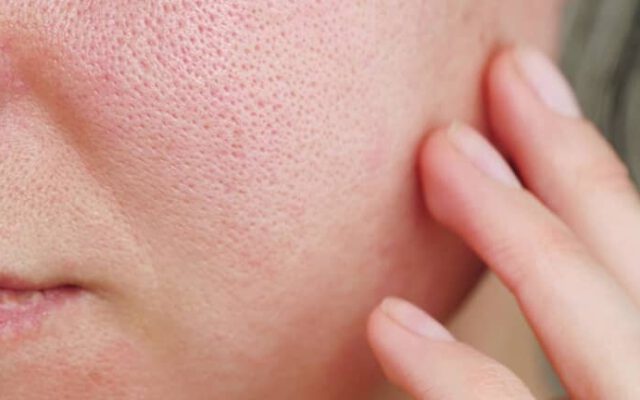 درمان منافذ باز پوست + علت تشکیل آن