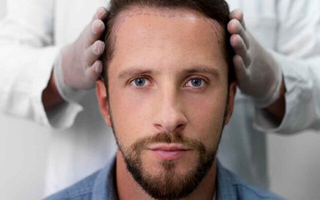 درمان شوره سر بعد از کاشت مو