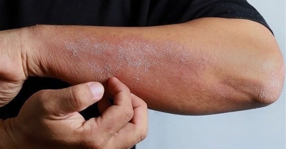 علت آلرژی و حساسیت پوستی چیست؟