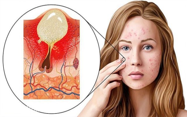درمان جوش زیر پوستی