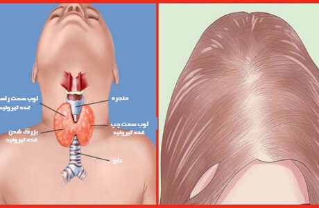 5 قرص برای درمان ریزش موی ناشی از تیروئید