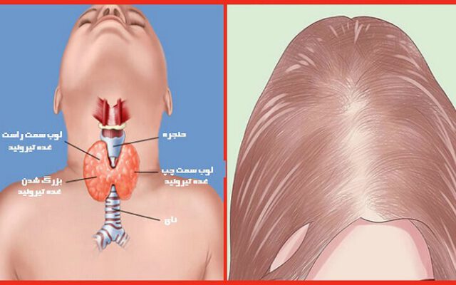 5 قرص برای درمان ریزش موی ناشی از تیروئید