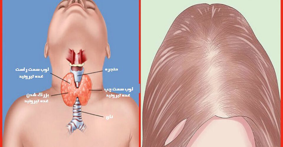 5 قرص برای درمان ریزش موی ناشی از تیروئید